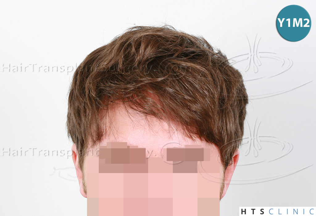Dr.Devroye-HTS-Clinic-1793-FUT-NW-IIA-5.jpg