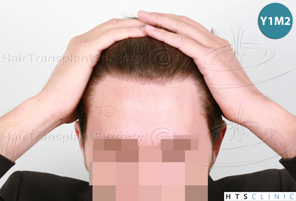 Dr.Devroye-HTS-Clinic-1793-FUT-NW-IIA-6.jpg