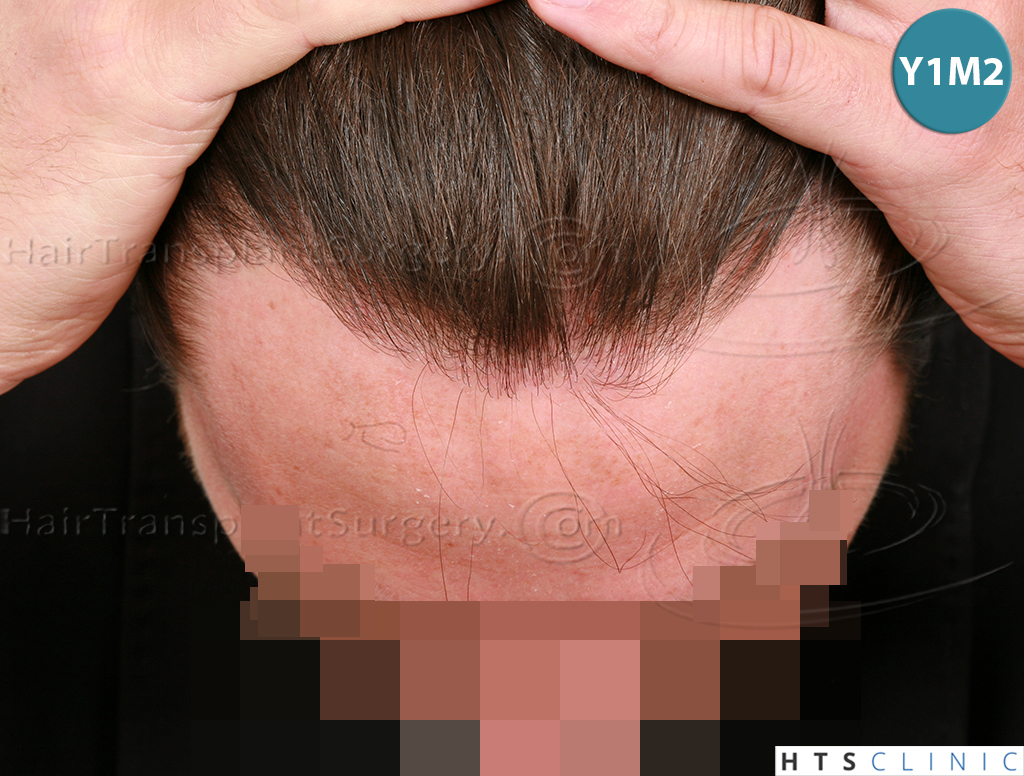Dr.Devroye-HTS-Clinic-1793-FUT-NW-IIA-8.jpg