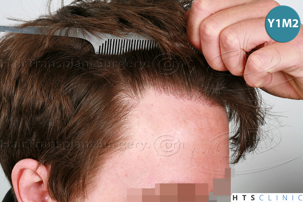 Dr.Devroye-HTS-Clinic-1793-FUT-NW-IIA-10.jpg