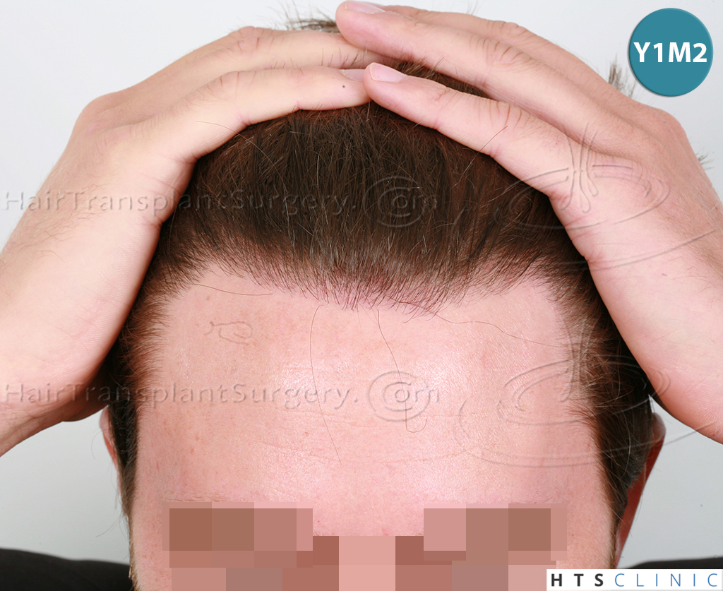 Dr.Devroye-HTS-Clinic-1793-FUT-NW-IIA-7.jpg