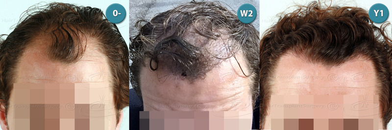 Dr.Devroye-HTS-Clinic-3117-FUT-NWIIIa-A.jpg