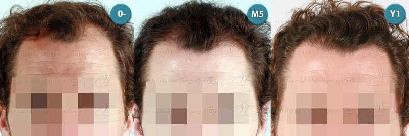 Dr.Devroye-HTS-Clinic-3117-FUT-NWIIIa-B.jpg