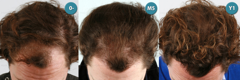 Dr.Devroye-HTS-Clinic-3117-FUT-NWIIIa-C.jpg
