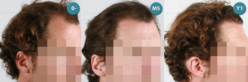 Dr.Devroye-HTS-Clinic-3117-FUT-NWIIIa-D.jpg