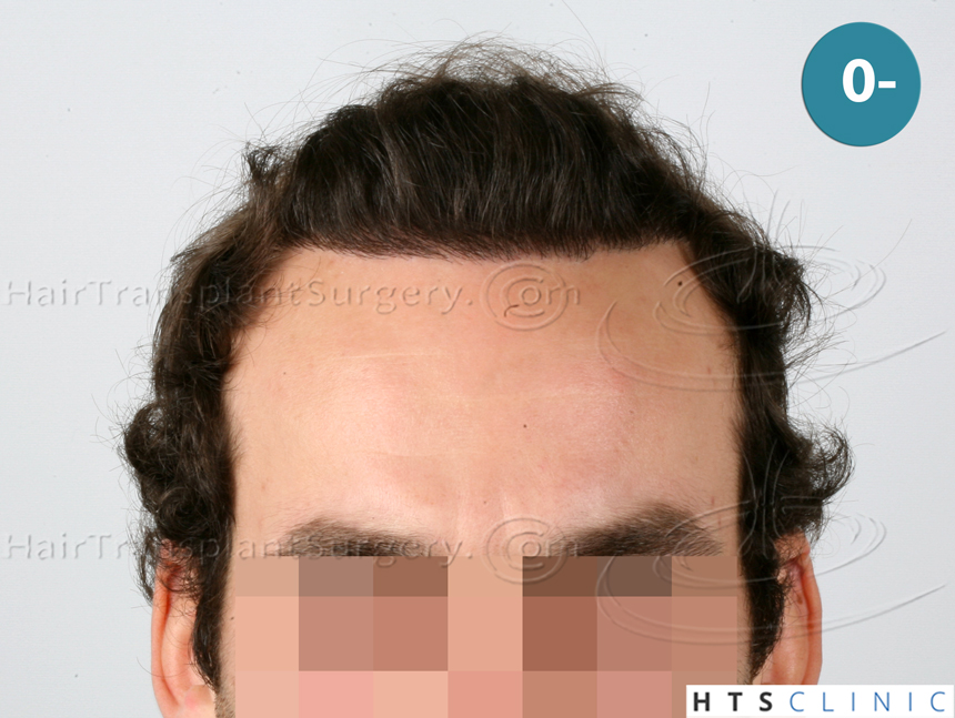 Dr.Devroye-HTS-Clinic-4658-FUT-1156-FUE-Combo-1.jpg