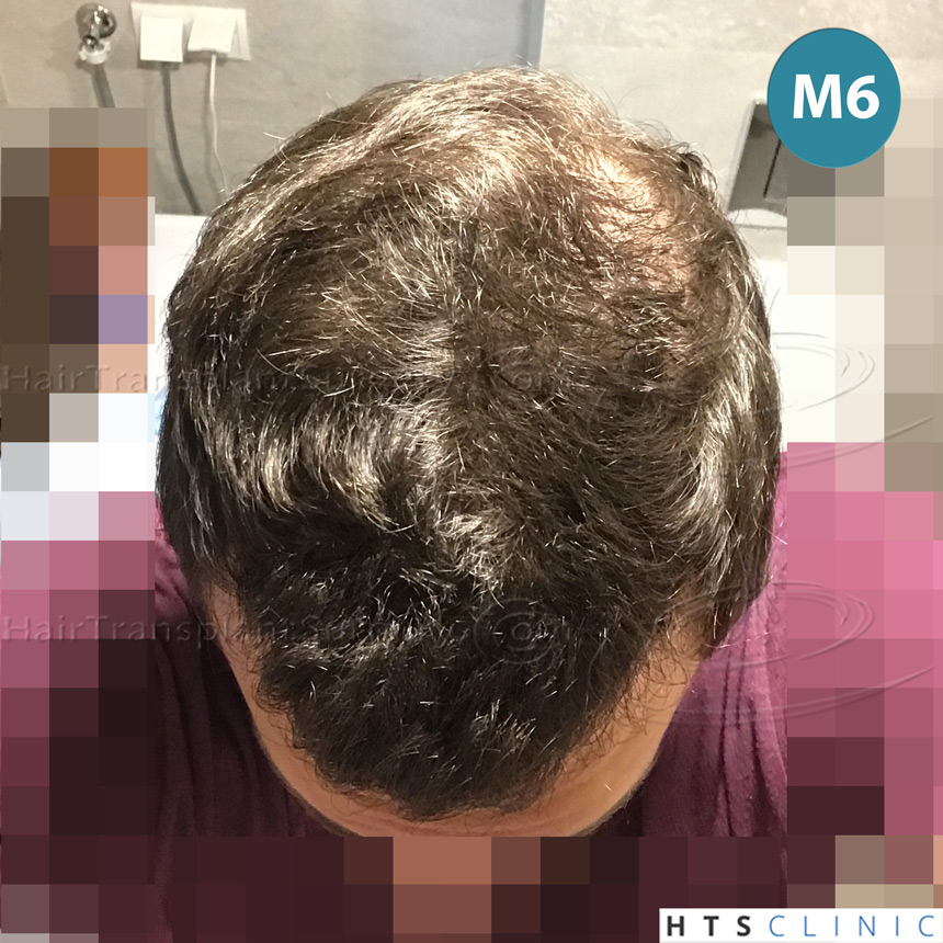 Dr.Devroye-HTS-Clinic-4658-FUT-1156-FUE-Combo-16.jpg