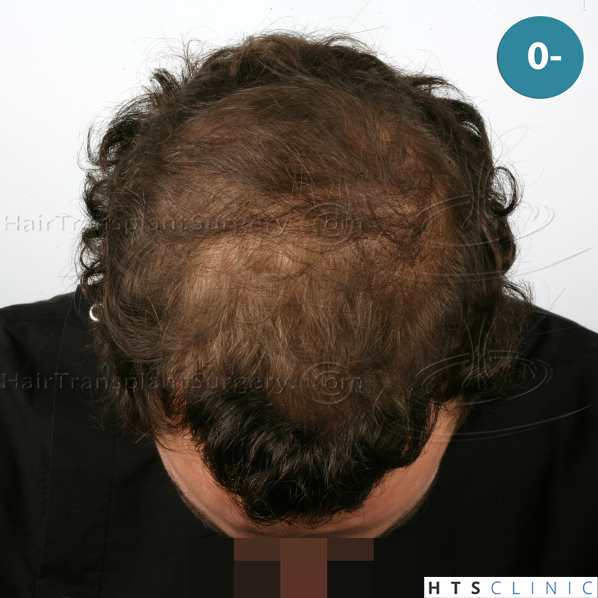 Dr.Devroye-HTS-Clinic-4658-FUT-1156-FUE-Combo-2.jpg