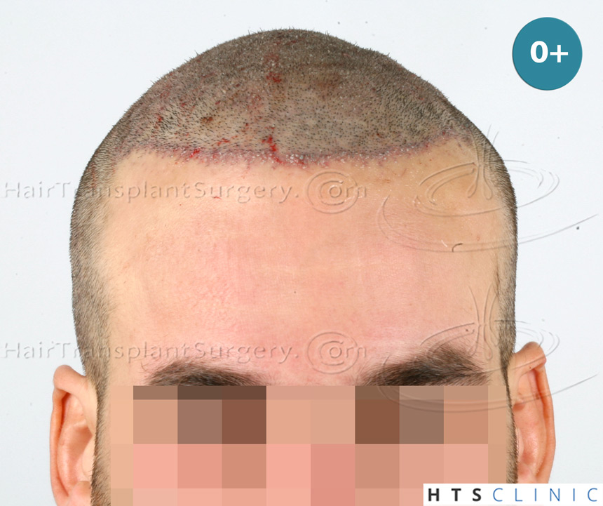 Dr.Devroye-HTS-Clinic-4658-FUT-1156-FUE-Combo-7.jpg