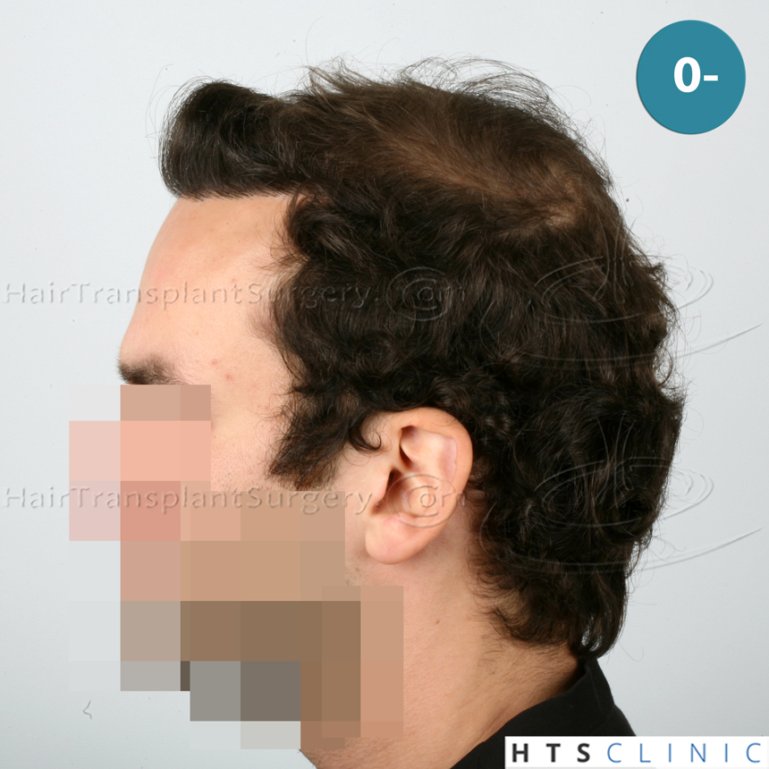 Dr.Devroye-HTS-Clinic-4658-FUT-1156-FUE-Combo-3.jpg