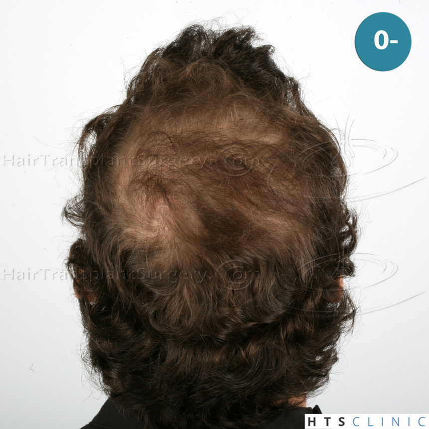 Dr.Devroye-HTS-Clinic-4658-FUT-1156-FUE-Combo-6.jpg