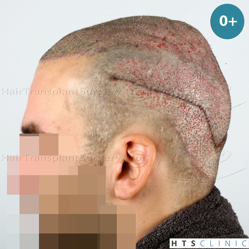 Dr.Devroye-HTS-Clinic-4658-FUT-1156-FUE-Combo-9.jpg