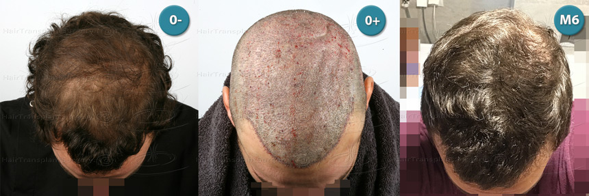 Dr.Devroye-HTS-Clinic-4658-FUT-1156-FUE-Combo-Montage.jpg