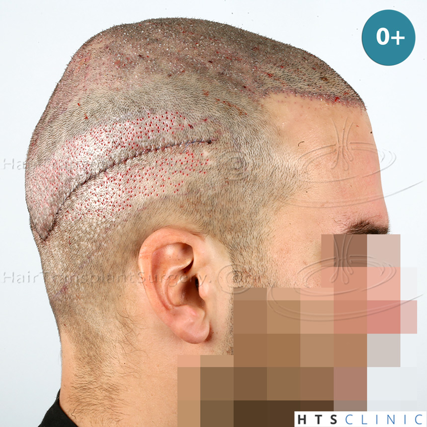 Dr.Devroye-HTS-Clinic-4658-FUT-1156-FUE-Combo-10.jpg