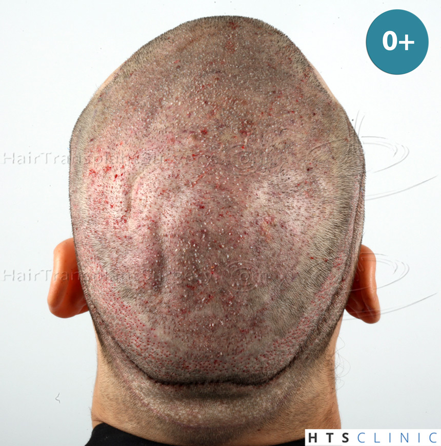 Dr.Devroye-HTS-Clinic-4658-FUT-1156-FUE-Combo-12.jpg