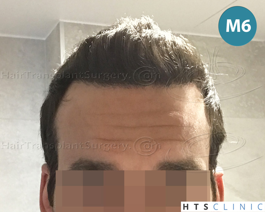 Dr.Devroye-HTS-Clinic-4658-FUT-1156-FUE-Combo-13.jpg