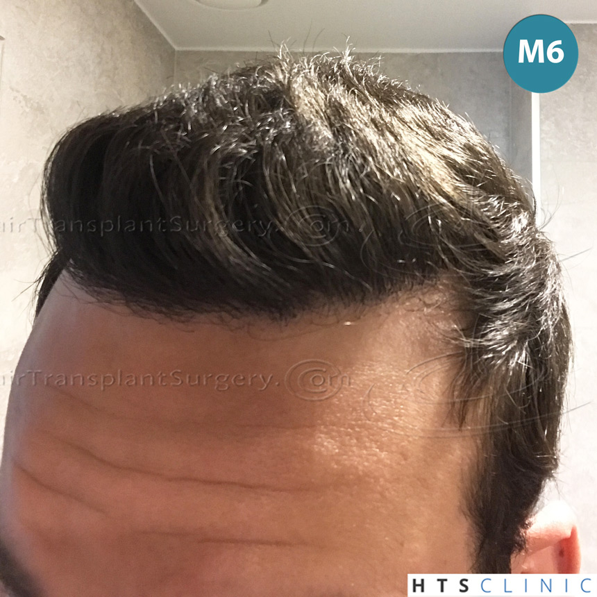 Dr.Devroye-HTS-Clinic-4658-FUT-1156-FUE-Combo-14.jpg