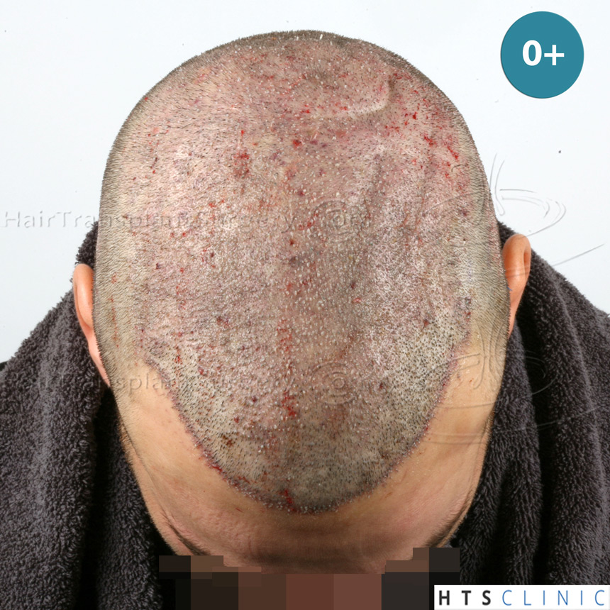 Dr.Devroye-HTS-Clinic-4658-FUT-1156-FUE-Combo-8.jpg