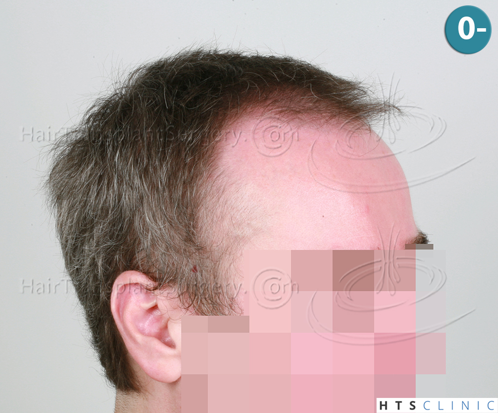 Dr.Devroye-HTS-Clinic-3616-FUT-NW-IIIA-4.jpg