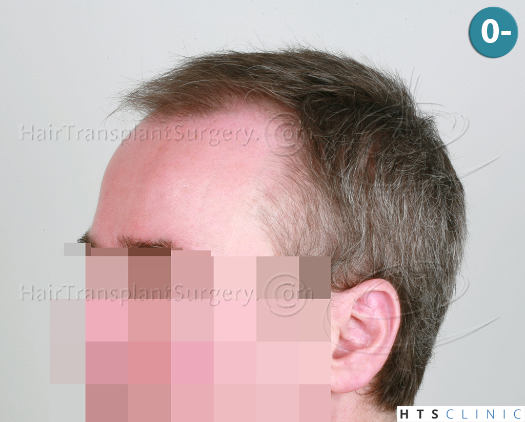 Dr.Devroye-HTS-Clinic-3616-FUT-NW-IIIA-3.jpg