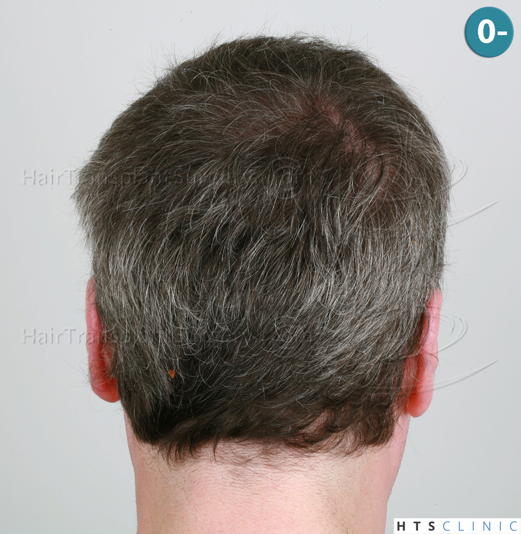 Dr.Devroye-HTS-Clinic-3616-FUT-NW-IIIA-5.jpg