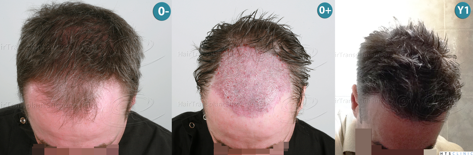 Dr.Devroye-HTS-Clinic-3616-FUT-NW-IIIA-Montage.jpg