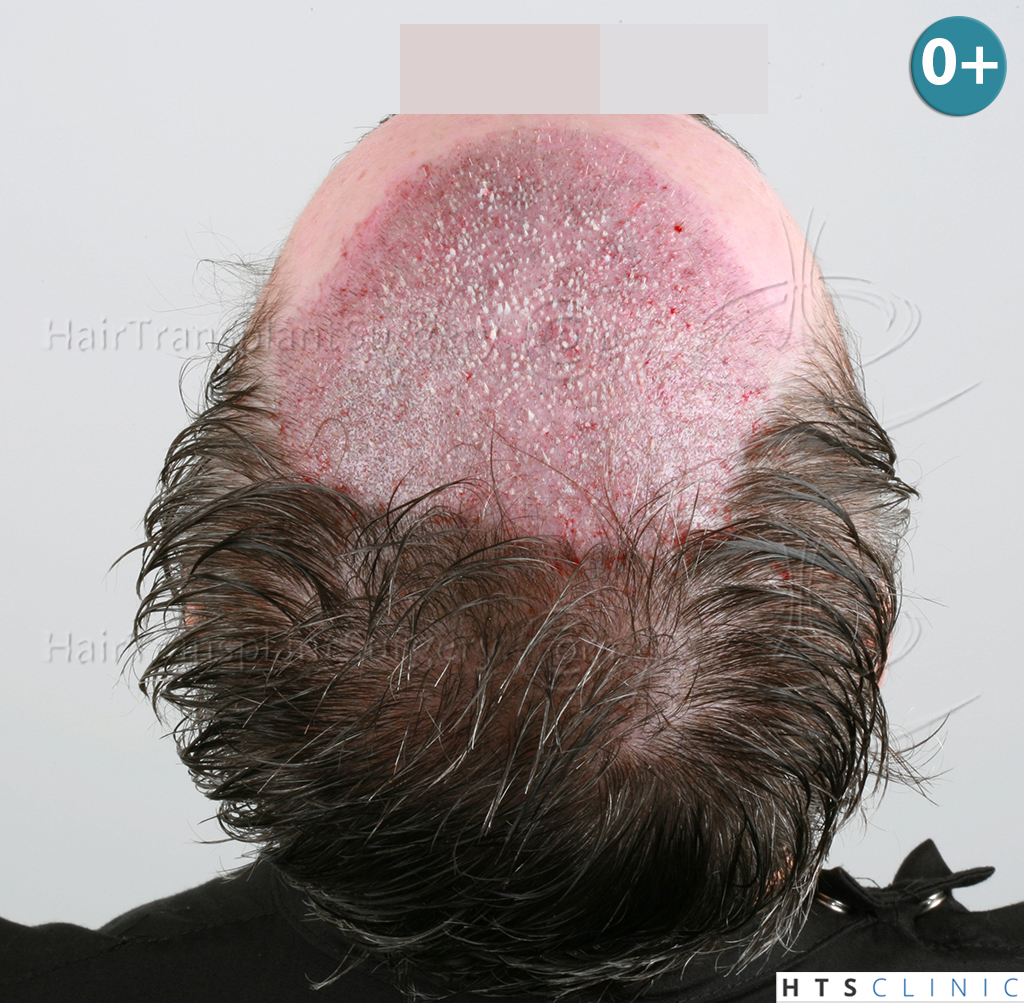 Dr.Devroye-HTS-Clinic-3616-FUT-NW-IIIA-11.jpg