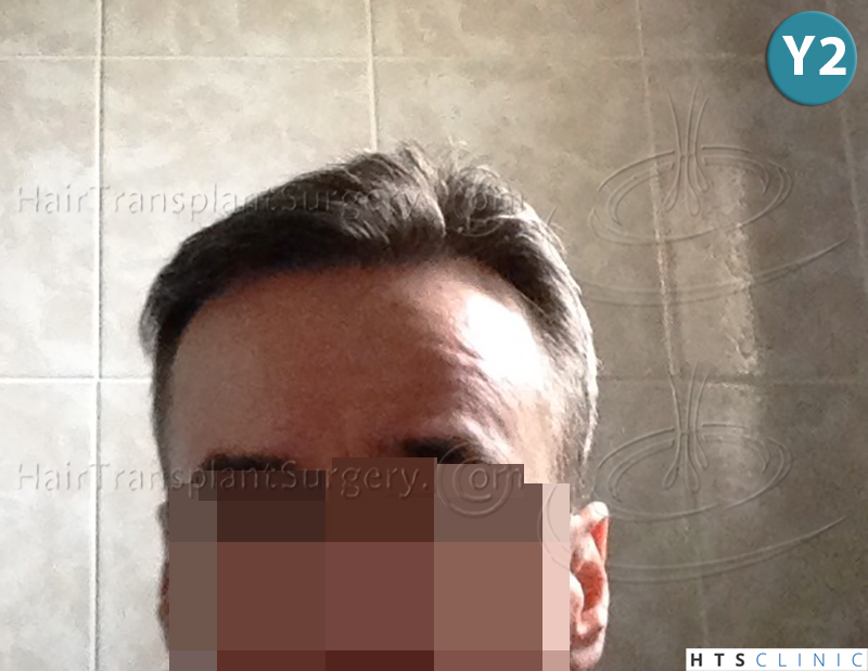 Dr.Devroye-HTS-Clinic-3616-FUT-NW-IIIA-16.jpg