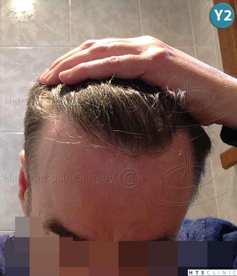 Dr.Devroye-HTS-Clinic-3616-FUT-NW-IIIA-17.jpg