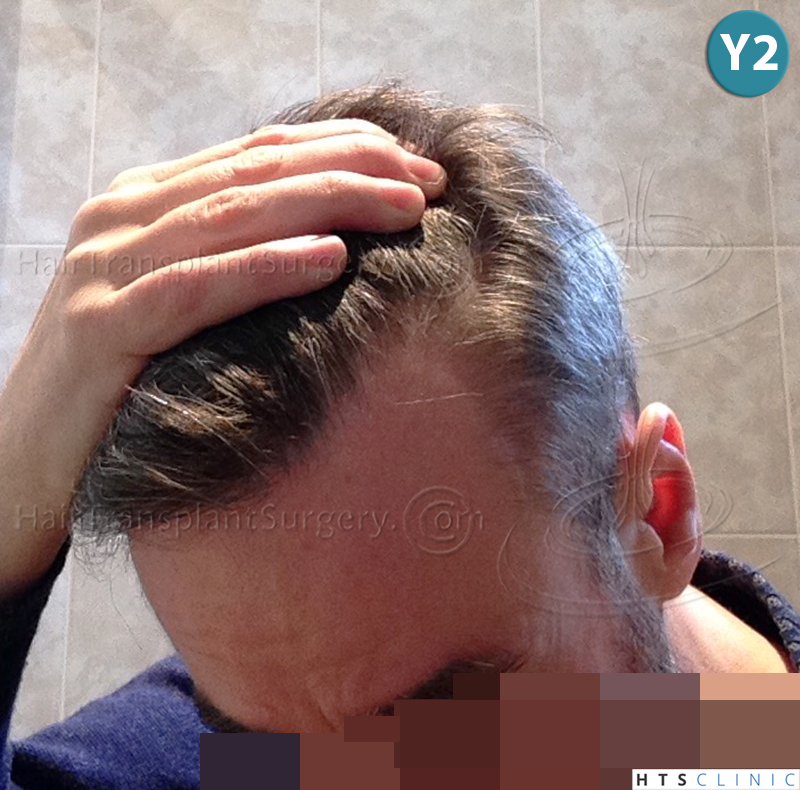 Dr.Devroye-HTS-Clinic-3616-FUT-NW-IIIA-19.jpg