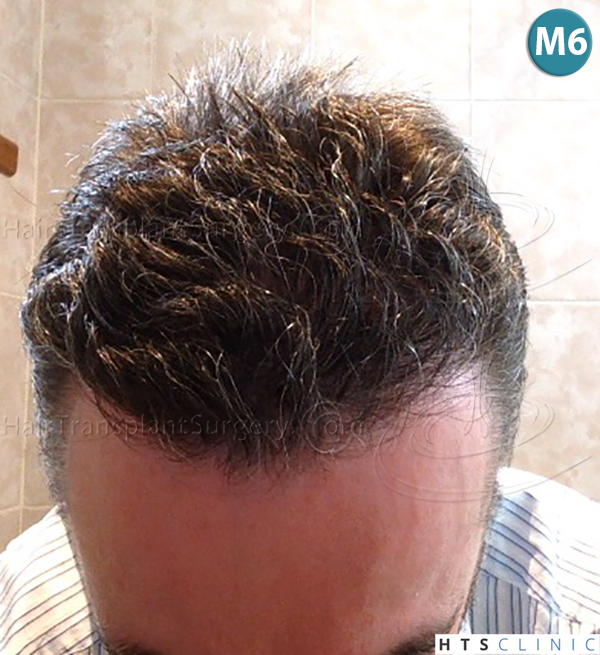 Dr.Devroye-HTS-Clinic-3616-FUT-NW-IIIA-23.jpg