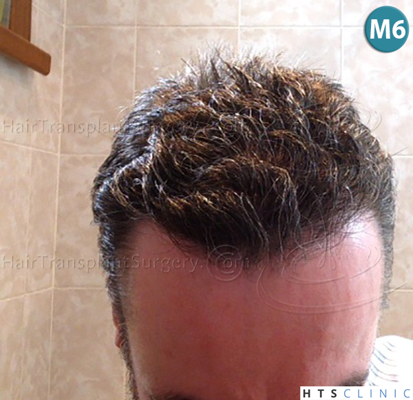 Dr.Devroye-HTS-Clinic-3616-FUT-NW-IIIA-24.jpg