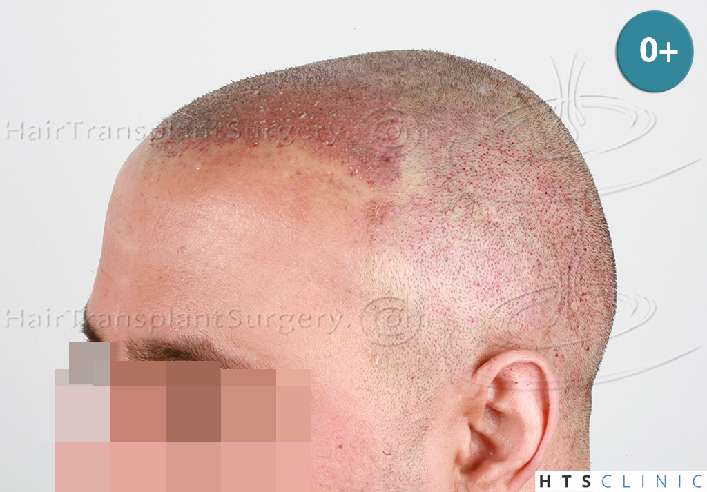 Dr.Devroye-HTS-Clinic-3090-FUE-NW-IV-7.jpg