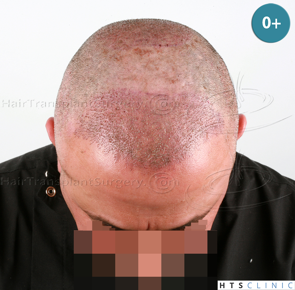 Dr.Devroye-HTS-Clinic-3090-FUE-NW-IV-6.jpg