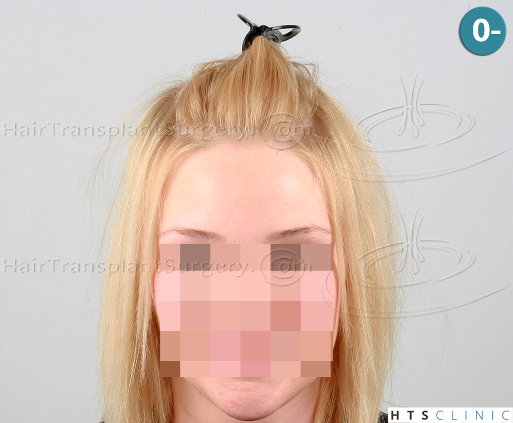 Dr.Devroye-HTS-Clinic-2693-FUT-Female-Traction-Alopecia-1.jpg