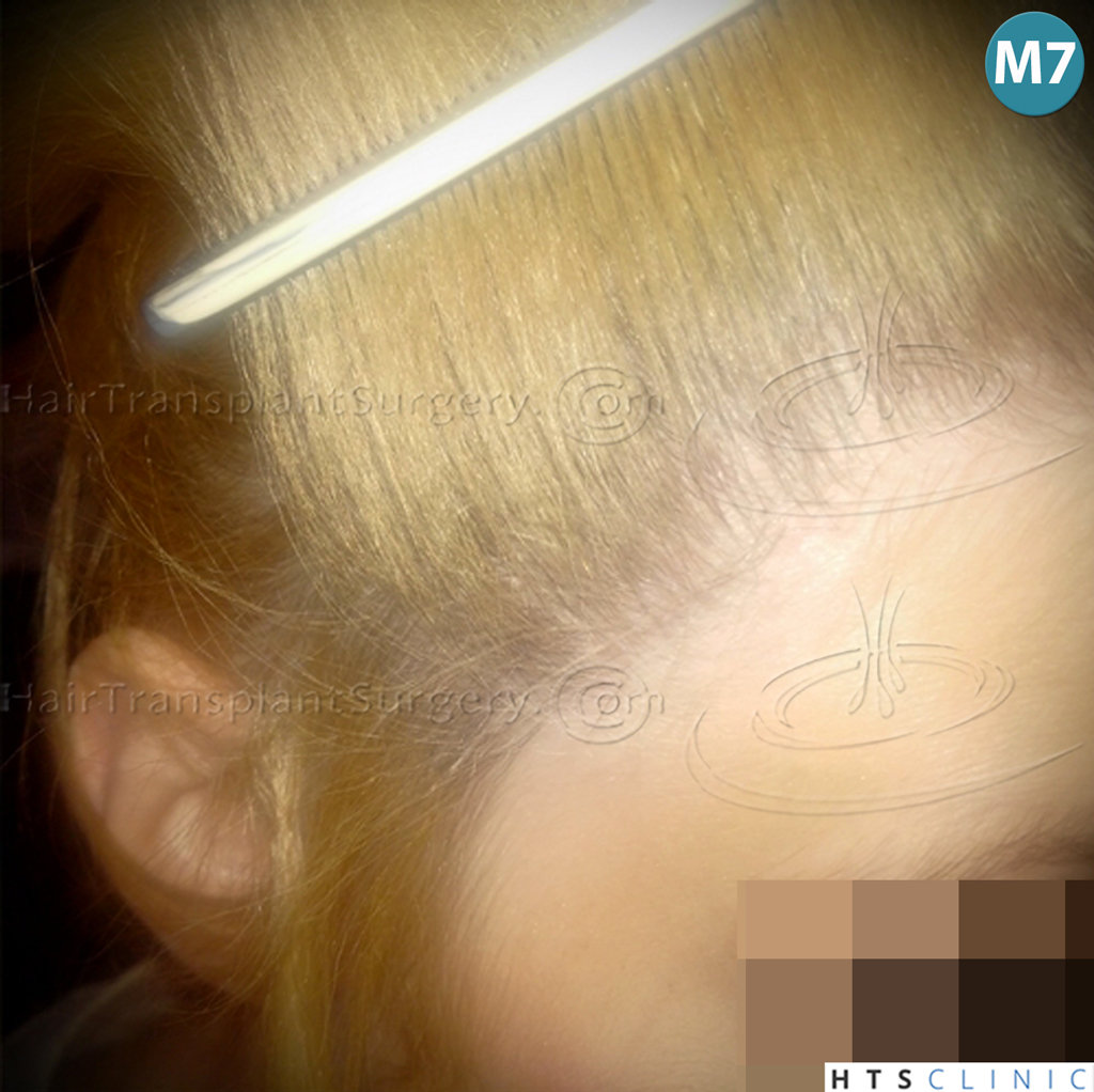Dr.Devroye-HTS-Clinic-2693-FUT-Female-Traction-Alopecia-22.jpg