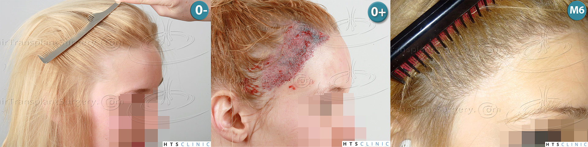 Dr.Devroye-HTS-Clinic-2693-FUT-Female-Traction-Alopecia-Montage1.jpg