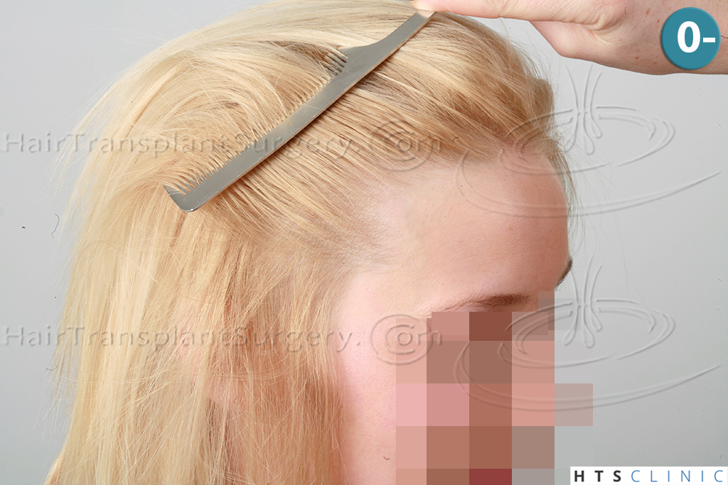 Dr.Devroye-HTS-Clinic-2693-FUT-Female-Traction-Alopecia-3.jpg