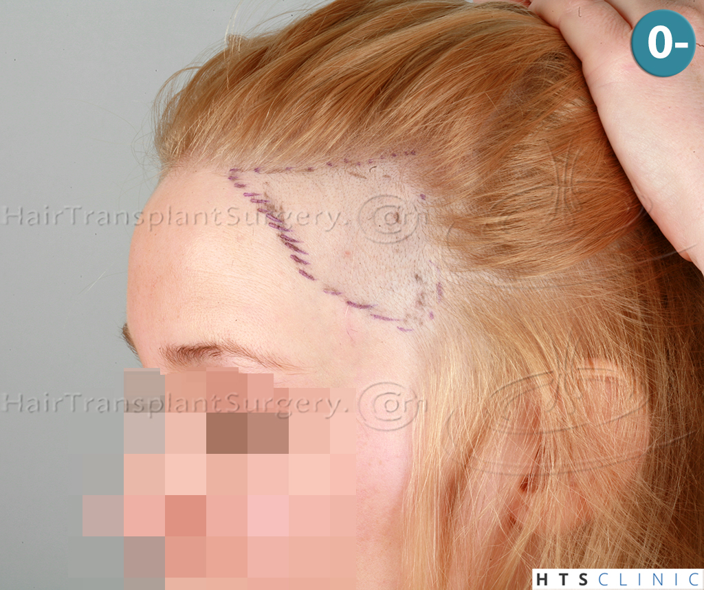 Dr.Devroye-HTS-Clinic-2693-FUT-Female-Traction-Alopecia-4.jpg