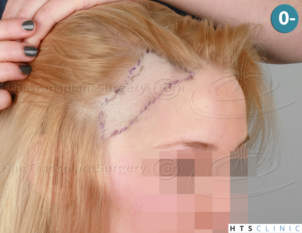 Dr.Devroye-HTS-Clinic-2693-FUT-Female-Traction-Alopecia-5.jpg