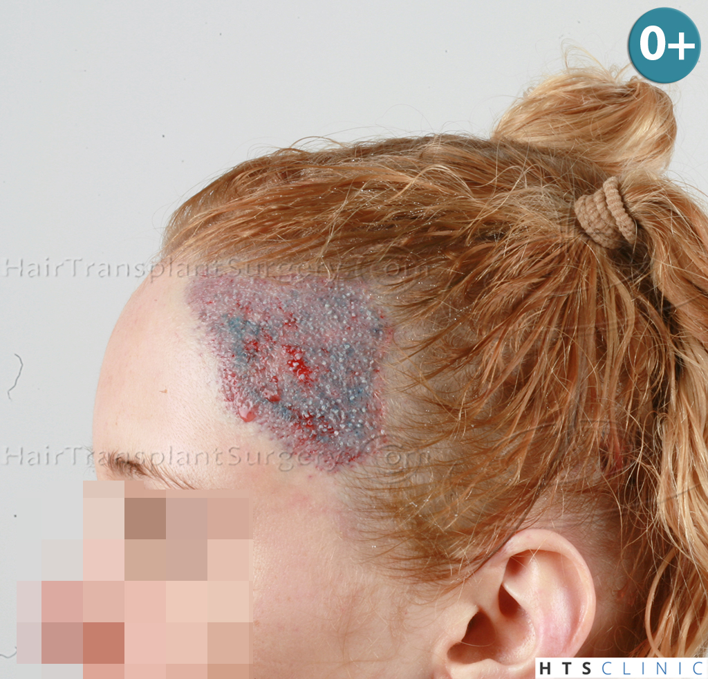 Dr.Devroye-HTS-Clinic-2693-FUT-Female-Traction-Alopecia-7.jpg