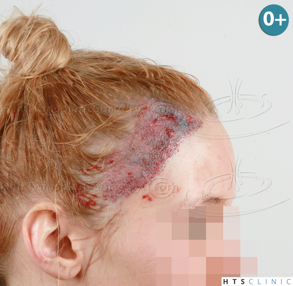 Dr.Devroye-HTS-Clinic-2693-FUT-Female-Traction-Alopecia-8.jpg