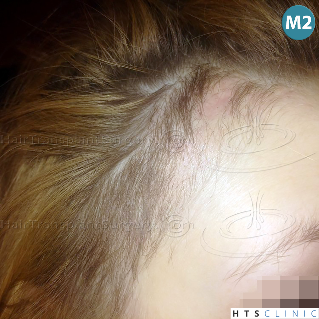 Dr.Devroye-HTS-Clinic-2693-FUT-Female-Traction-Alopecia-10.jpg