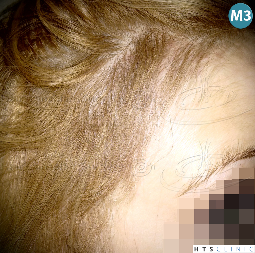 Dr.Devroye-HTS-Clinic-2693-FUT-Female-Traction-Alopecia-13.jpg