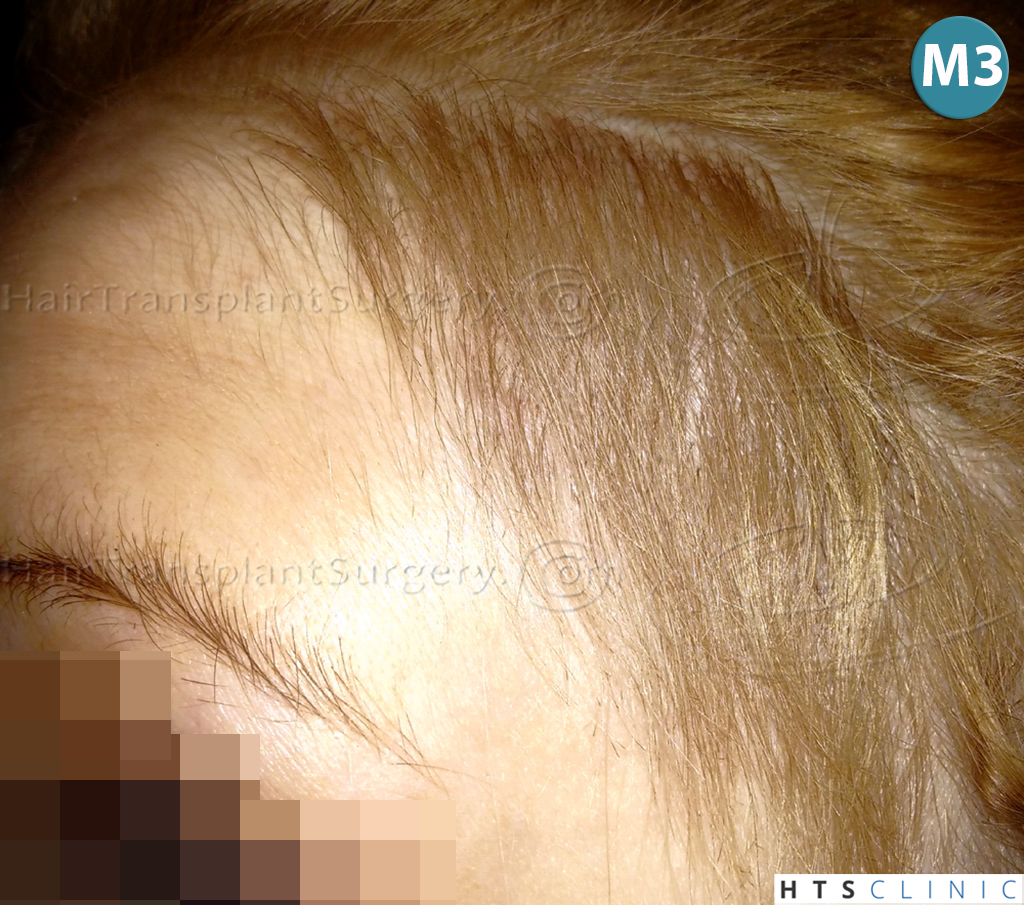 Dr.Devroye-HTS-Clinic-2693-FUT-Female-Traction-Alopecia-12.jpg