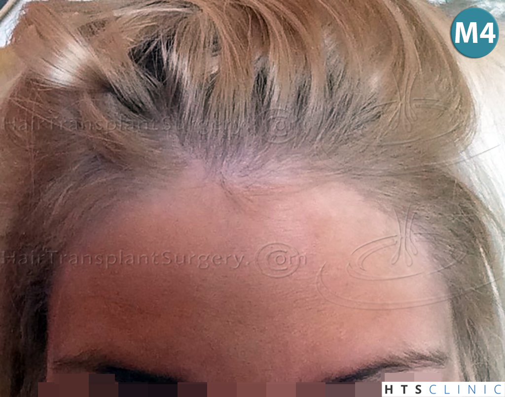 Dr.Devroye-HTS-Clinic-2693-FUT-Female-Traction-Alopecia-14.jpg