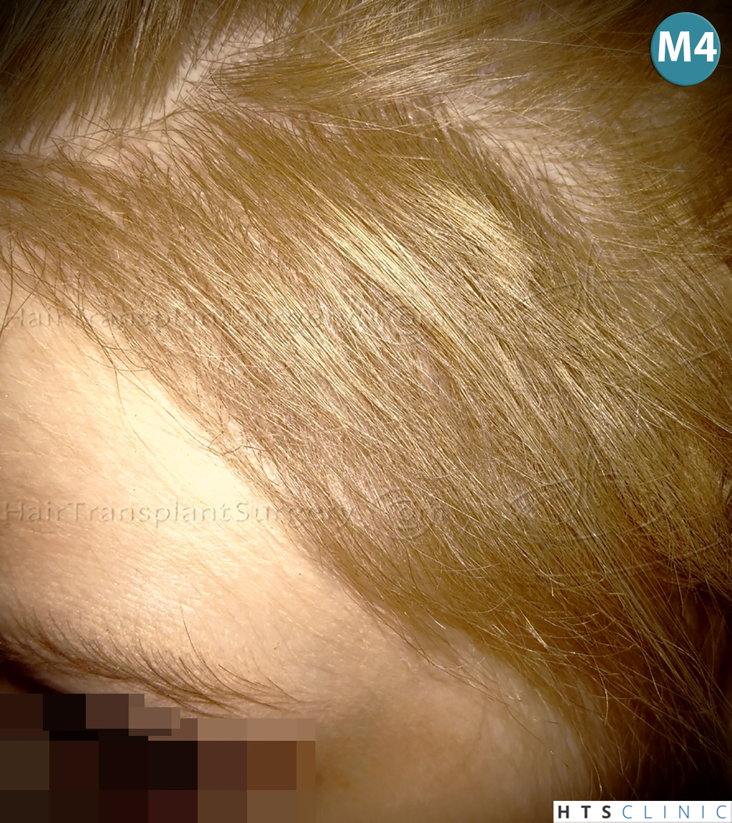 Dr.Devroye-HTS-Clinic-2693-FUT-Female-Traction-Alopecia-15.jpg