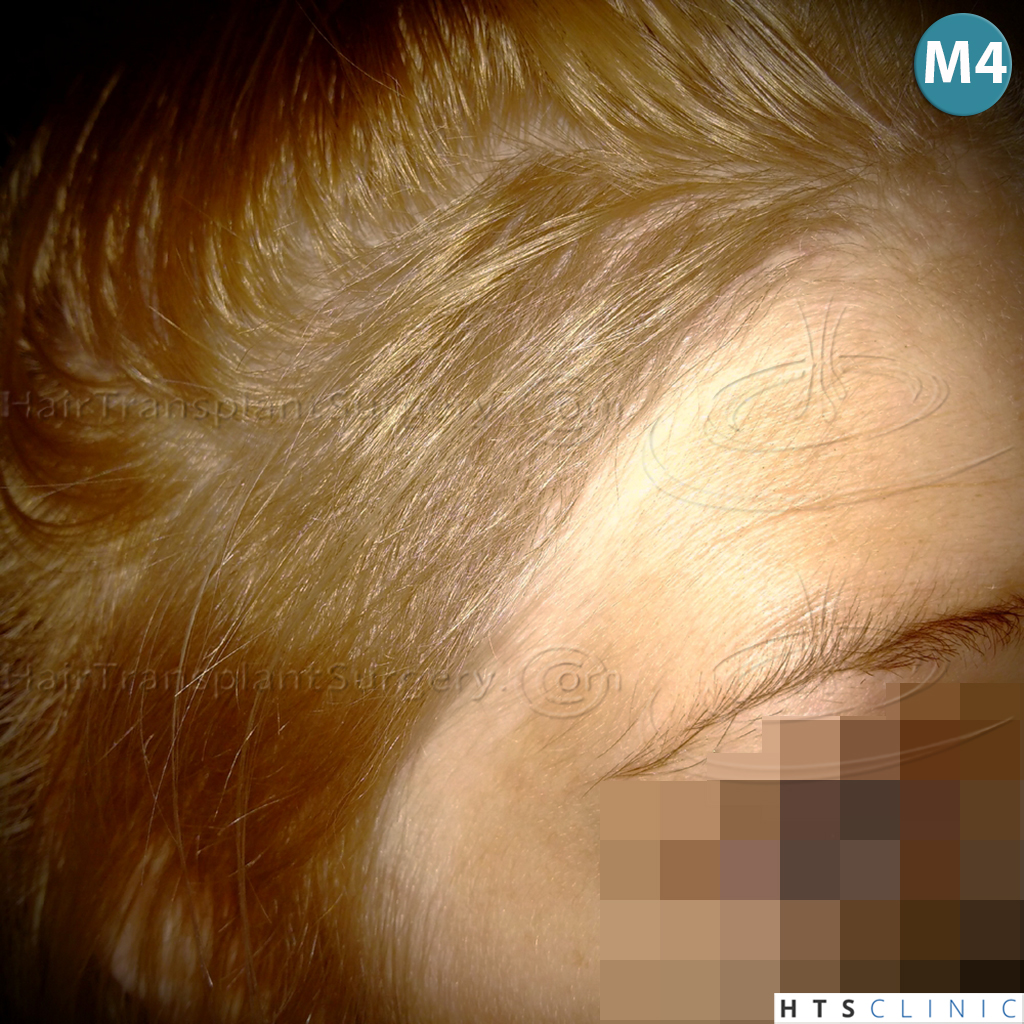 Dr.Devroye-HTS-Clinic-2693-FUT-Female-Traction-Alopecia-16.jpg