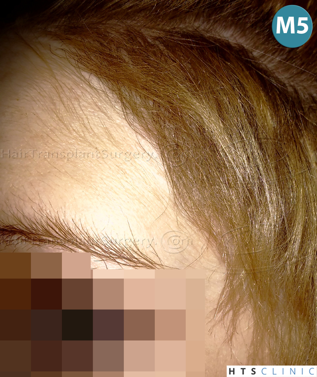 Dr.Devroye-HTS-Clinic-2693-FUT-Female-Traction-Alopecia-18.jpg