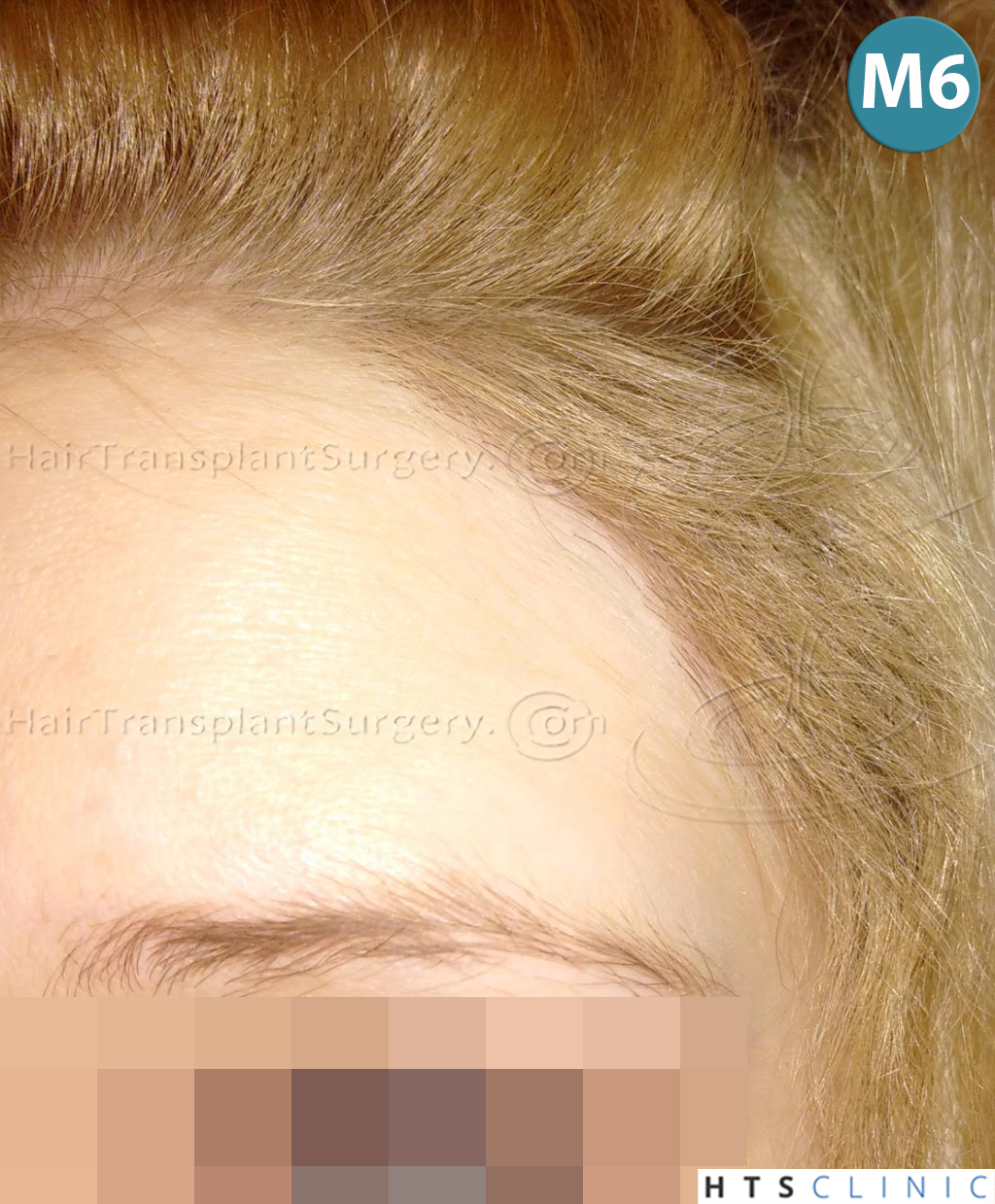 Dr.Devroye-HTS-Clinic-2693-FUT-Female-Traction-Alopecia-20.jpg